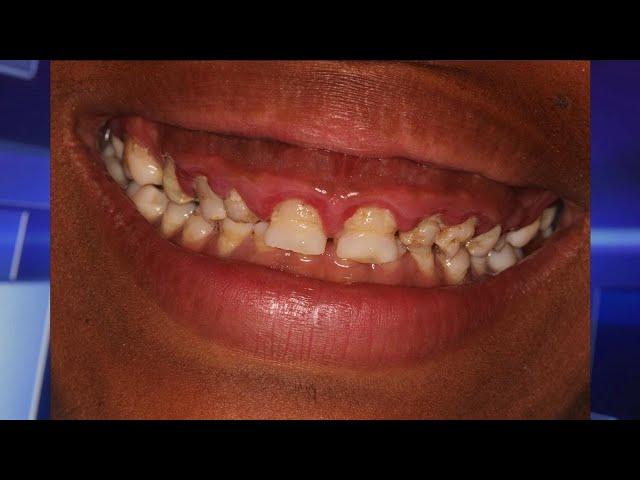 See Woman’s New Smile After Total Mouth Makeover