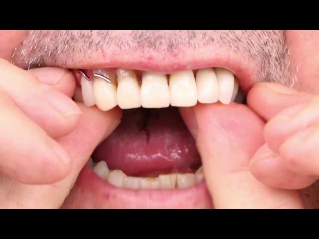 Partial Denture Video