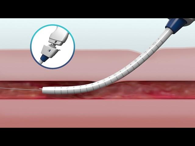 MANTA Vascular Closure Device Overview