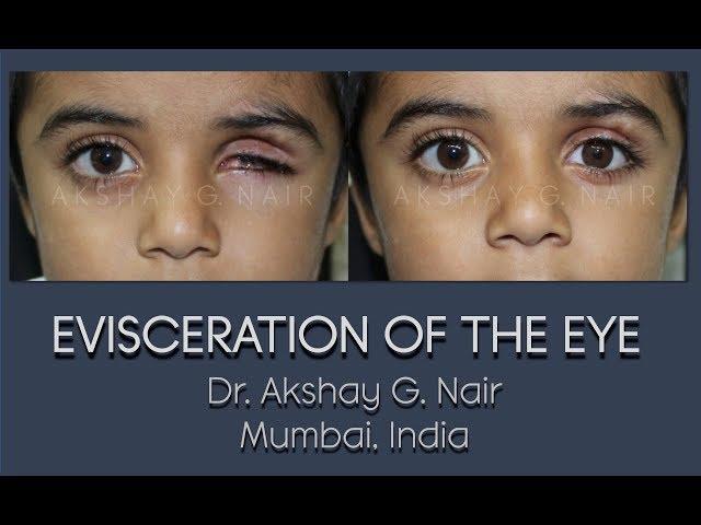 Ocular Evisceration (Eye Removal) HD Video: Dr Akshay G Nair, Mumbai