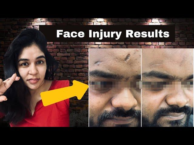 Injury scar on face treatment by lasers and surgery- 9999 747 717