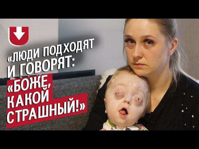 У моего сына синдром Пфайффера: Катя | Быть мамой