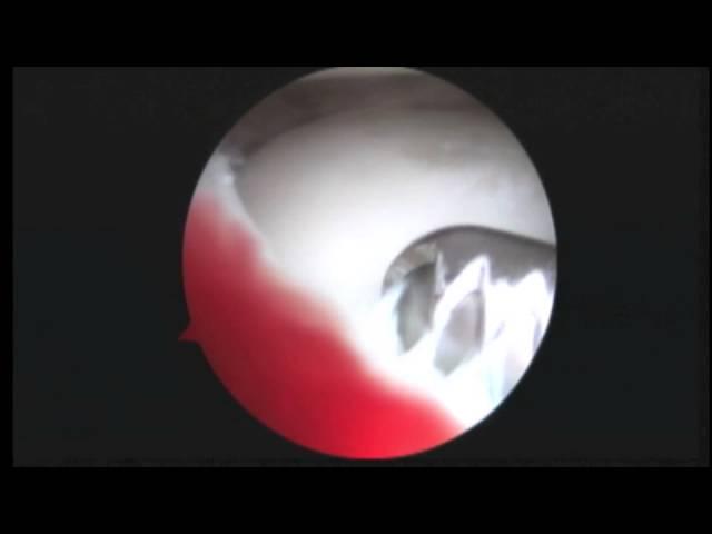 MR Bilateral knee scopes, L Knee discoid lat meniscus12.19.13