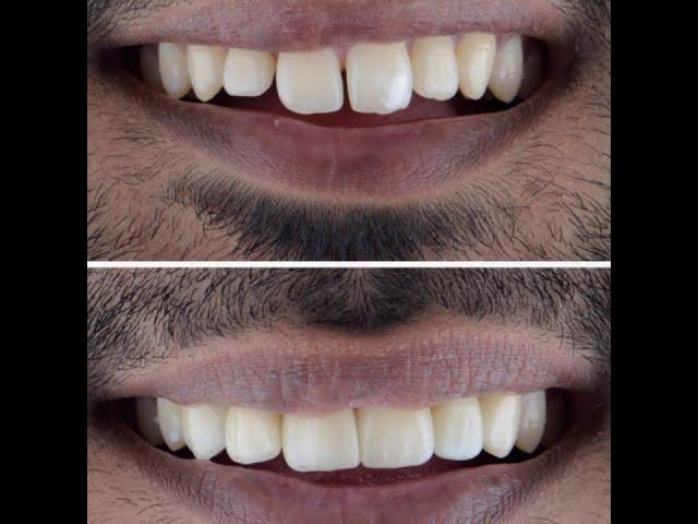 Veneers| Best Dental| Smile change| Smile Makeover| We Dental| Dr Arshad| E max| New Smile| Cbe