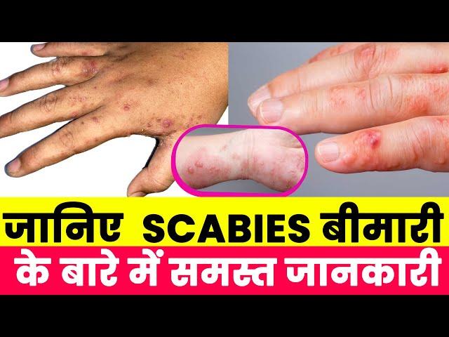 जानिए  Scabies बीमारी के बारे में समस्त जानकारी Dr Ajay Jain