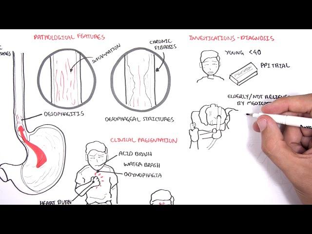 GORD (GERD) Gastro Oesophageal Reflux Disease  - Overview pathophysiology, treatment