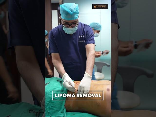 Lipoma cure | Multiple Lipoma removal #shorts