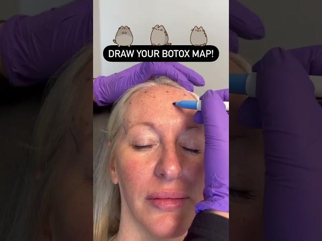 Draw Your Botox Map