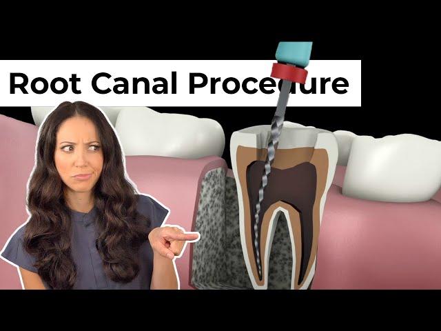 Root Canal Procedure Step by Step