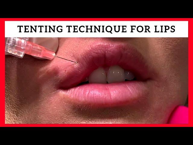 Tenting Technique for Lip Enhancement by Dr. Steven F Weiner