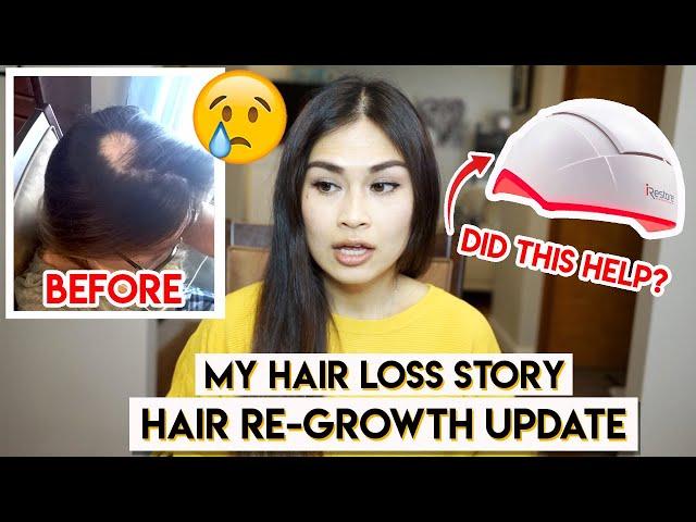 MY HAIR LOSS STORY (ALOPECIA AREATA)⎮iRestore LASER HAIR GROWTH SYSTEM 1-year UPDATE⎮BEFORE & AFTER