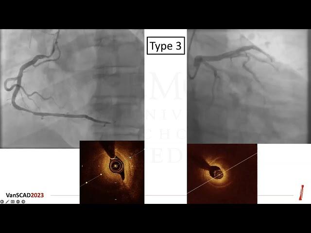 Spontaneous Coronary Artery Dissection (SCAD) Update