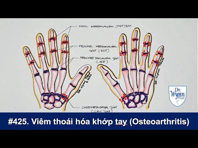 #425. Viêm thoái hóa khớp bàn tay (Hand Osteoarthritis) và cách phân biệt với viêm thấp khớp (RA)