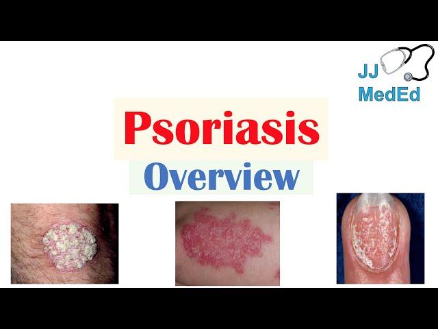 Overview of Psoriasis | What Causes It? What Makes It Worse? | Subtypes and Treatment