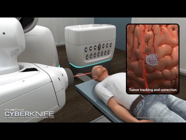 CyberKnife Brain Tumor Animation