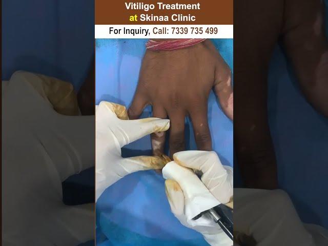 Vitiligo treatment at skinaa clinic #vitiligomodel #vitiligo #shorts #viralshorts  #skinaaclinic