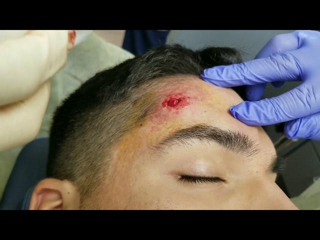 Forehead Lipoma Excision