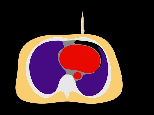 POCUS - Lung Ultrasound: How to diagnose a pneumothorax with ultrasound.