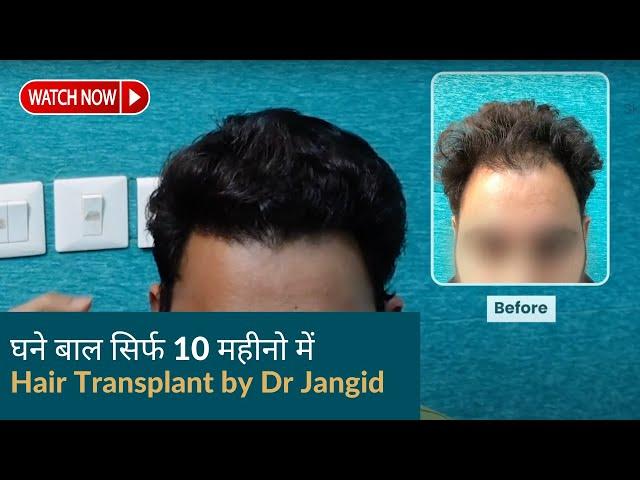 Hair Transplant of a doctor | Before & After 10 महीनो के बाद | Hair transplant results in delhi