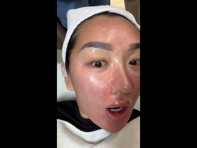 12 LASER SKIN TREATMENTS IN KOREA
