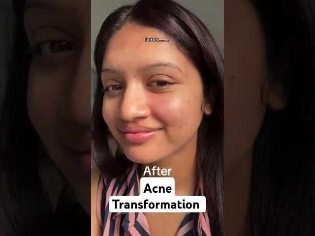 Acne transformation Credits : mamata_3793 via IG #acnejourney #acnetreament #acne