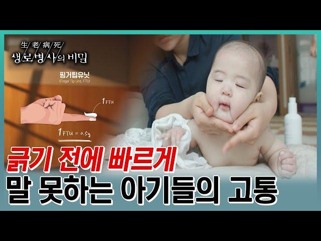 영유아기에 가장 많이 발현되는 아토피 피부염. 아기한테 스테로이드나 아토피 치료약을 쓰기가 두렵다고 마냥 피할수 없는 이유 (KBS 20230628 방송)