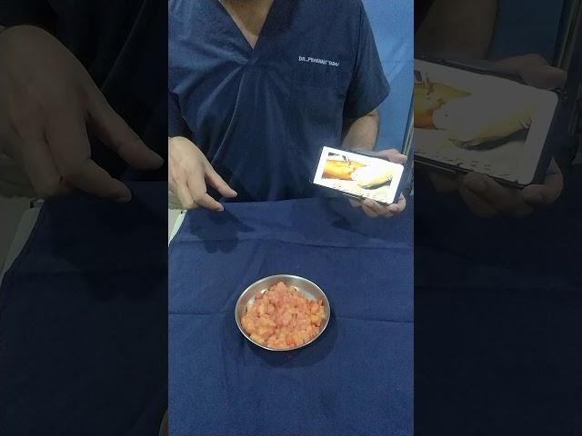 Lipoma Removal Delhi !! Dr. Prashant Yadav