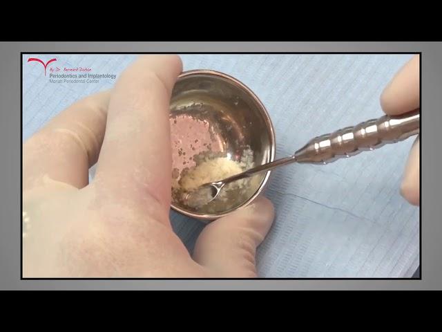 Socket Preservation after Failing Implants - Lateral Augmentation Course Private Academy