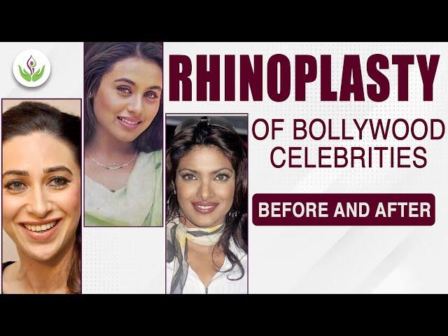 Rhinoplasty of Bollywood Celebrities Before And After | Bollywood Actress Who Did Plastic Surgery?