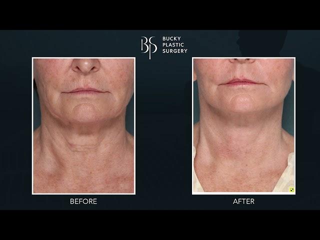 Revolutionizing Neck Rejuvenation with Dilute Fat - Dr. Louis P. Bucky