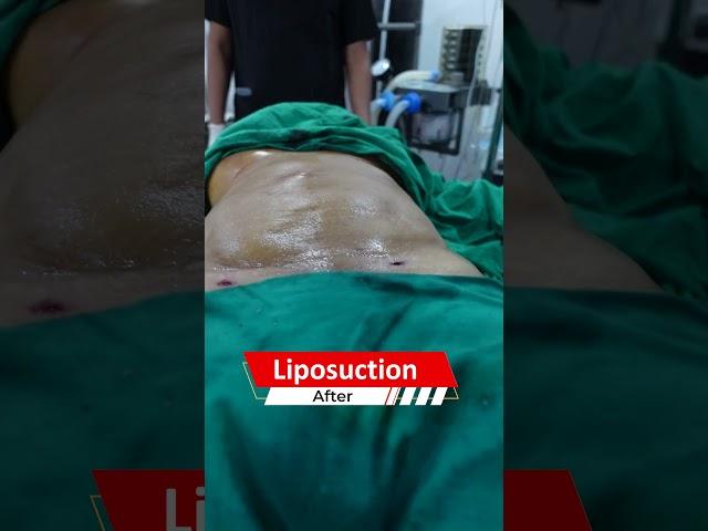 Liposuction surgery before and after results | Dezire Clinic #drprashantyadav #shorts #shortvideo