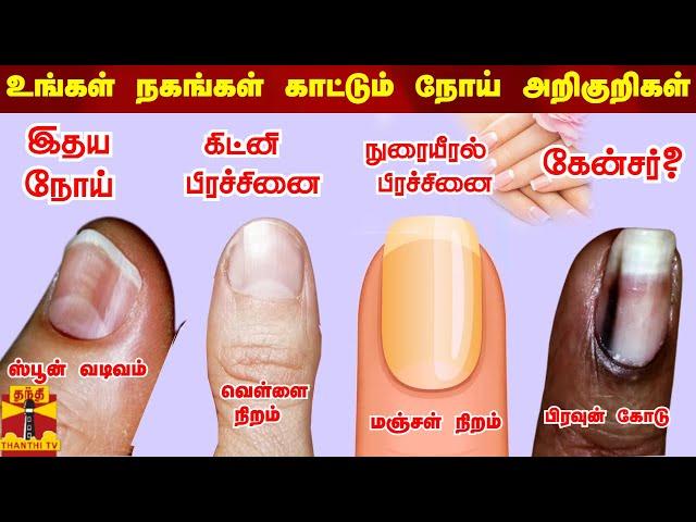 உங்கள் நகங்கள் காட்டும் நோய் அறிகுறிகள் | Nail disease