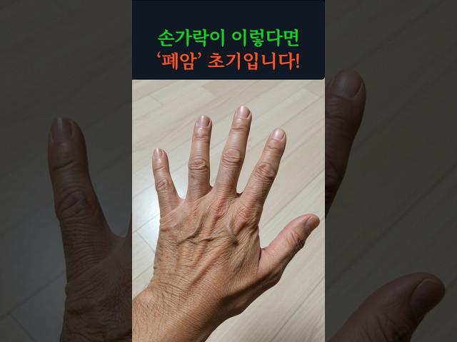 손가락 모양이 이렇다면, 폐암의 신호일 수 있습니다!