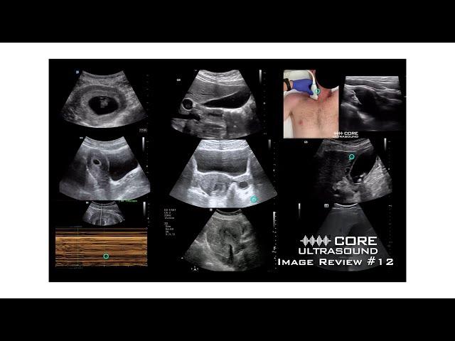 Core Ultrasound Image Review #12!