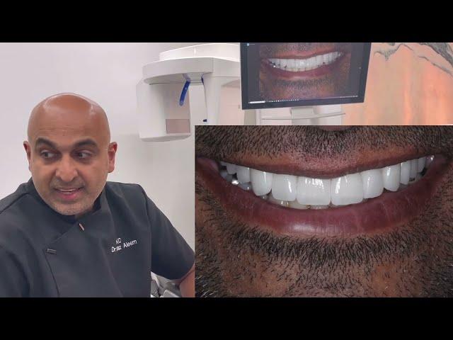 Smile Design with Feldspathic Veneers, Implants and Implant Crowns