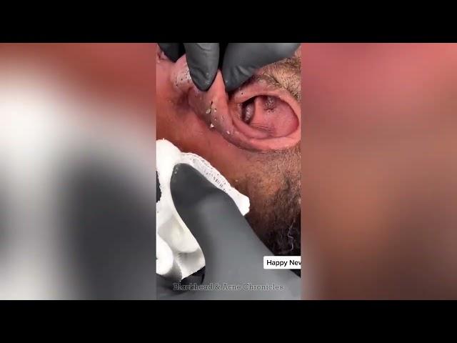 Satisfying Blackhead Removal on TikTok | Ultimate ASMR Relaxation | Best of the week! Ear acne clear