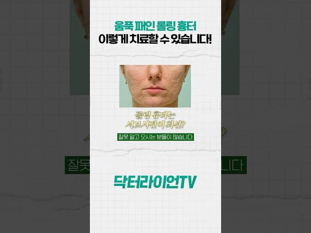 움푹 패인 볼, 관자 쪽 여드름 흉터, 무조건 서브시전 시술법만이 정답일까? #여드름흉터