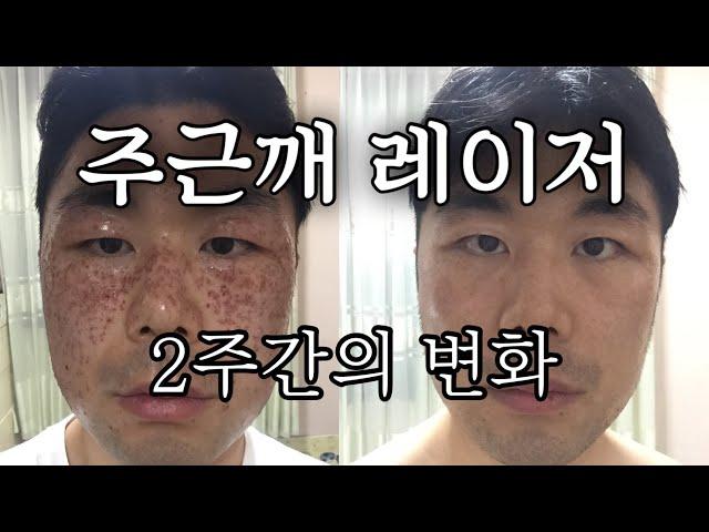 기미 주근깨 레이저 2주간의 변화