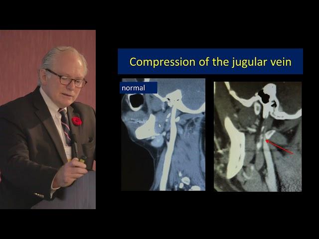 Fraser Henderson Neurological Manifestations of Hereditary Hypermobility Connective Tissue Disorders