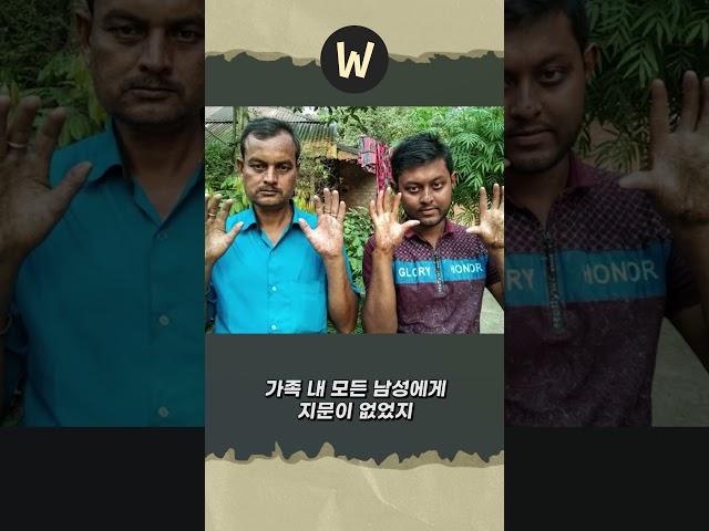 지문이 없는 사람도 있다고?