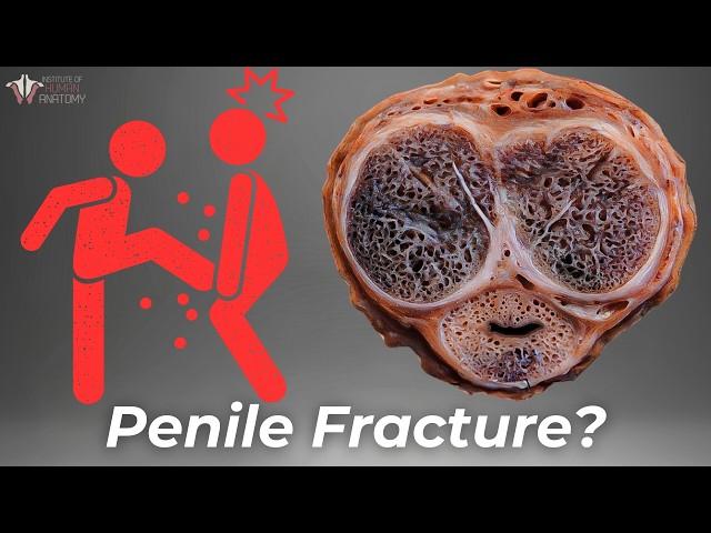 The Fracture You Don't Want - Penile Fractures