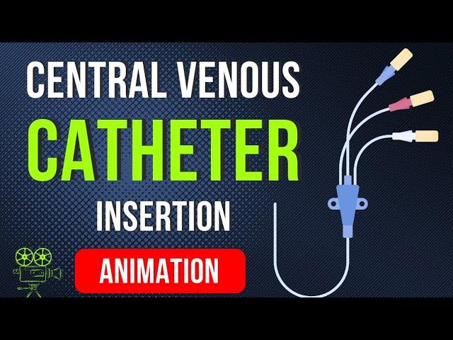  CENTRAL VENOUS CATHETER (CVC) INSERTION PROCEDURE | ANIMATED EXPLANATION