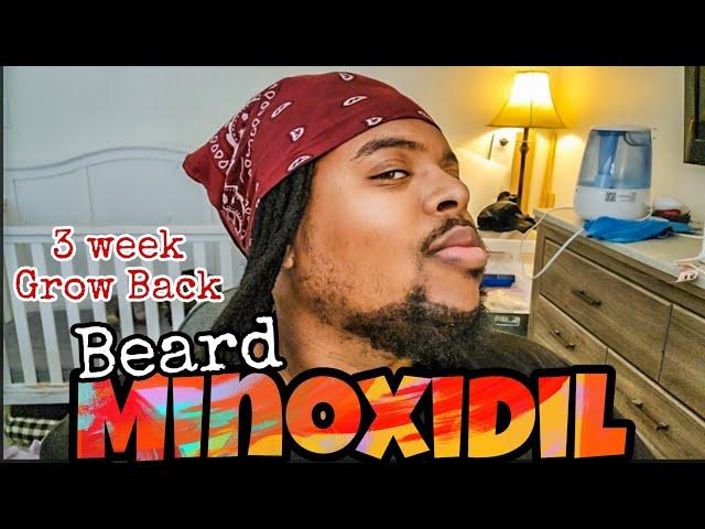 Growing Beard With Minoxidil Week 3 The Grow Back