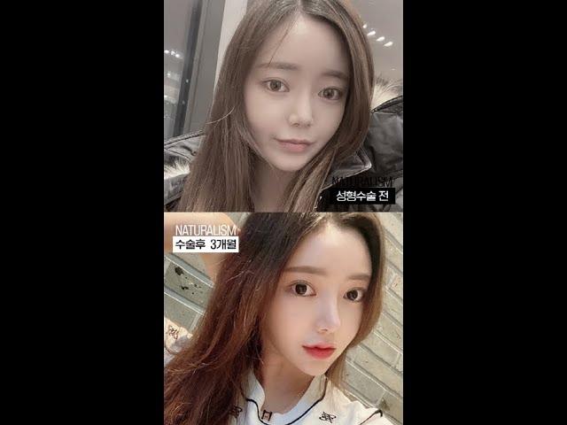 자연주의성형외과 쌍수+코재수술 수술전후 영상