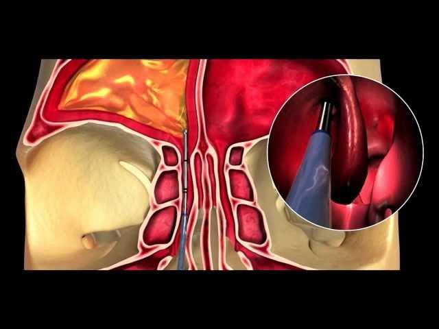 Balloon Sinus Dilation Animation