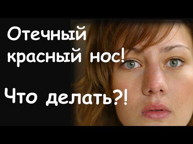 Отечный красный нос. Что делать?!