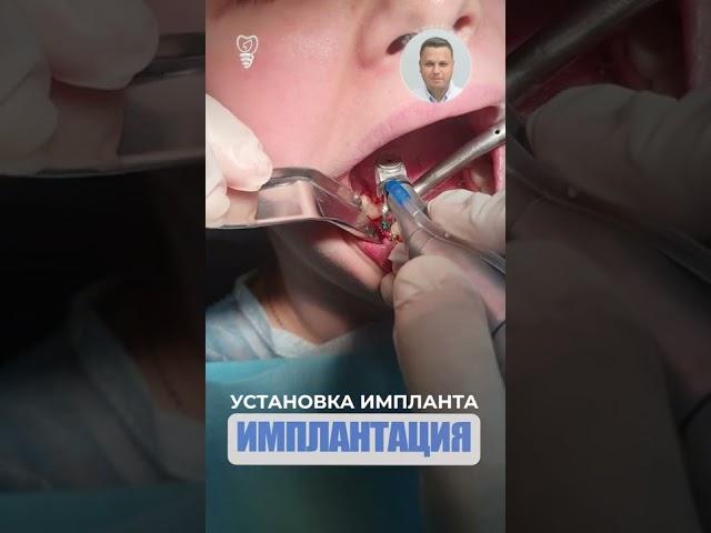 Установка импланта. Implant installation.