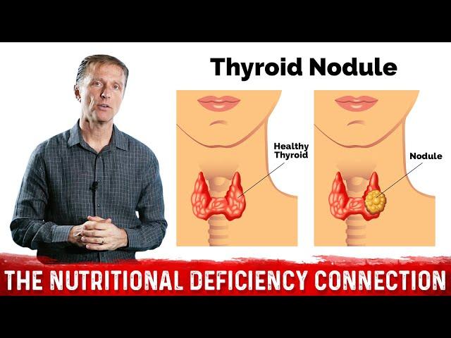 What's Behind Thyroid Nodules? Thyroid Disorders & Selenium Deficiency – Dr.Berg