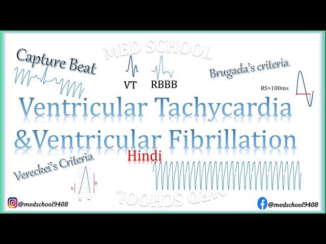 Ventricular Tachycardia and Ventricular Fibrillation Hindi