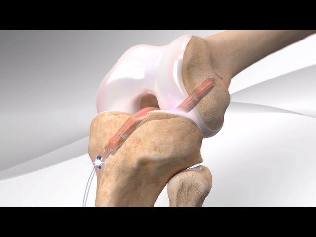 All-Inside ACL Reconstruction with Arthrex® GraftLink®